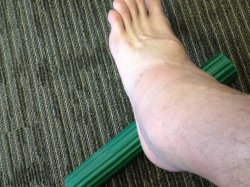Mansfield TX Ankle Injuries